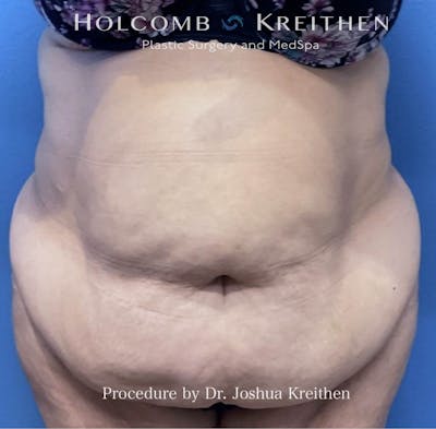 Lower Body Lift Before & After Gallery - Patient 190060 - Image 1