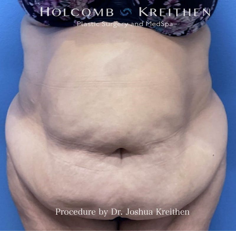 Lower Body Lift Before & After Gallery - Patient 190060 - Image 1
