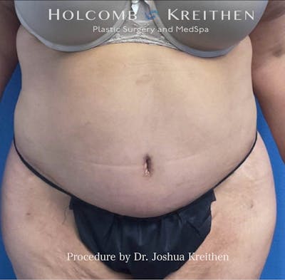 Lower Body Lift Before & After Gallery - Patient 190060 - Image 2