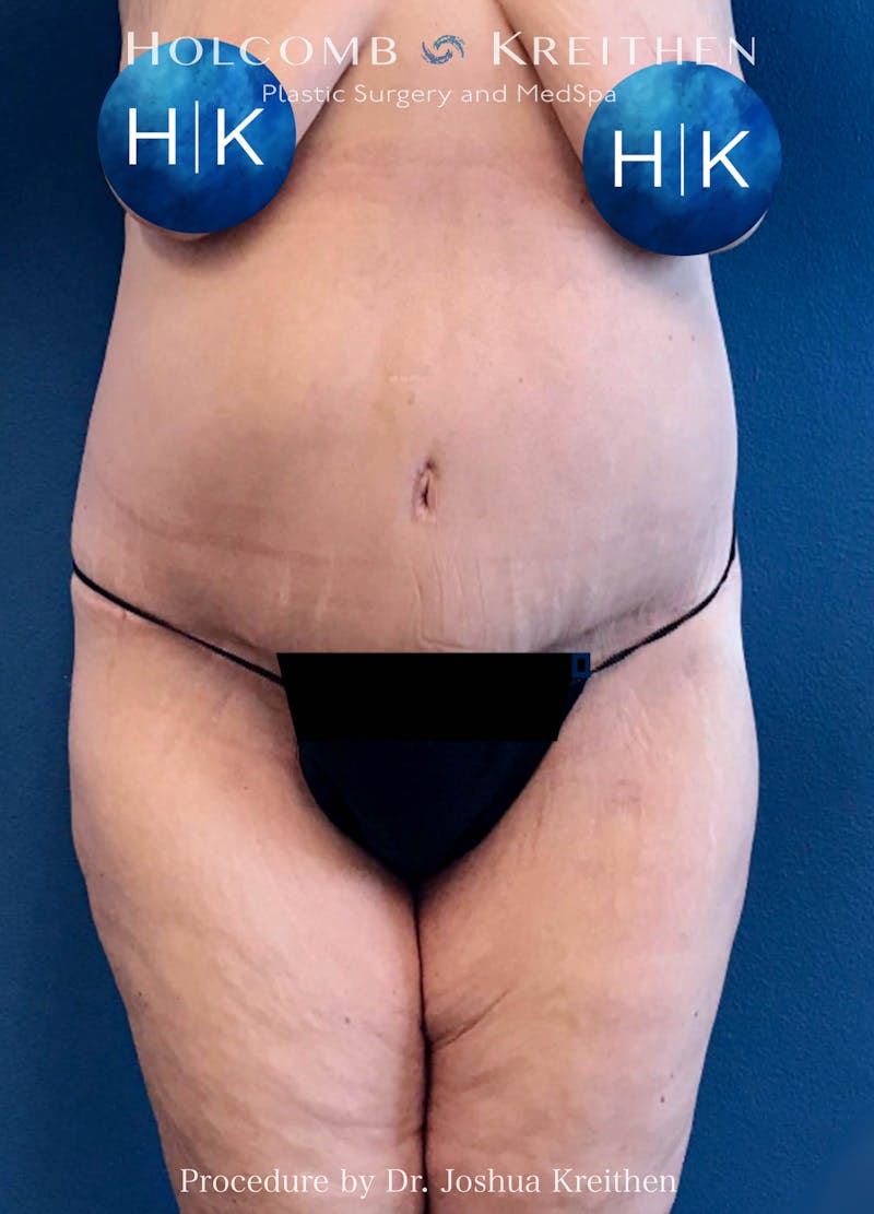 Lower Body Lift Before & After Gallery - Patient 123968 - Image 2