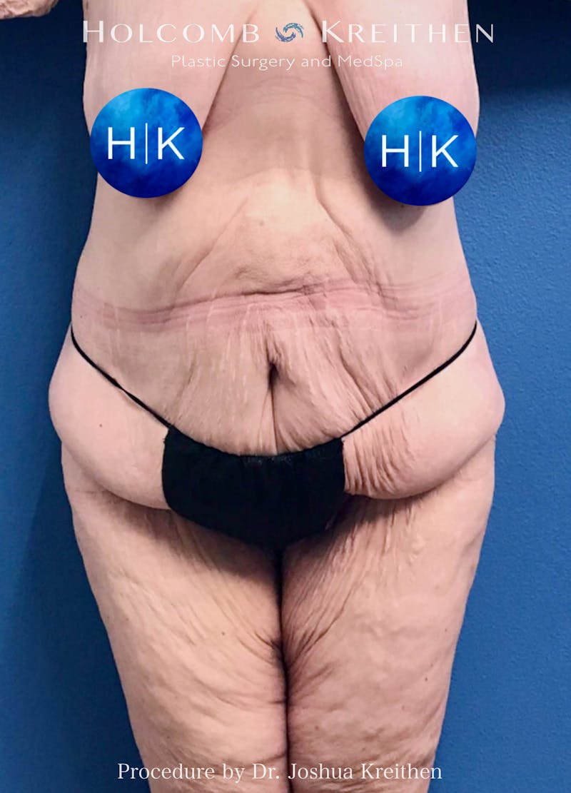 Lower Body Lift Before & After Gallery - Patient 123968 - Image 1