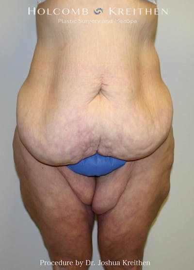 Lower Body Lift Before & After Gallery - Patient 357664 - Image 1
