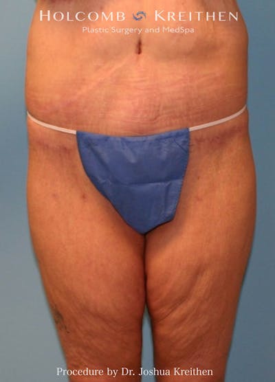 Lower Body Lift Before & After Gallery - Patient 642692 - Image 2