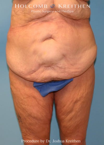 Lower Body Lift Before & After Gallery - Patient 642692 - Image 1