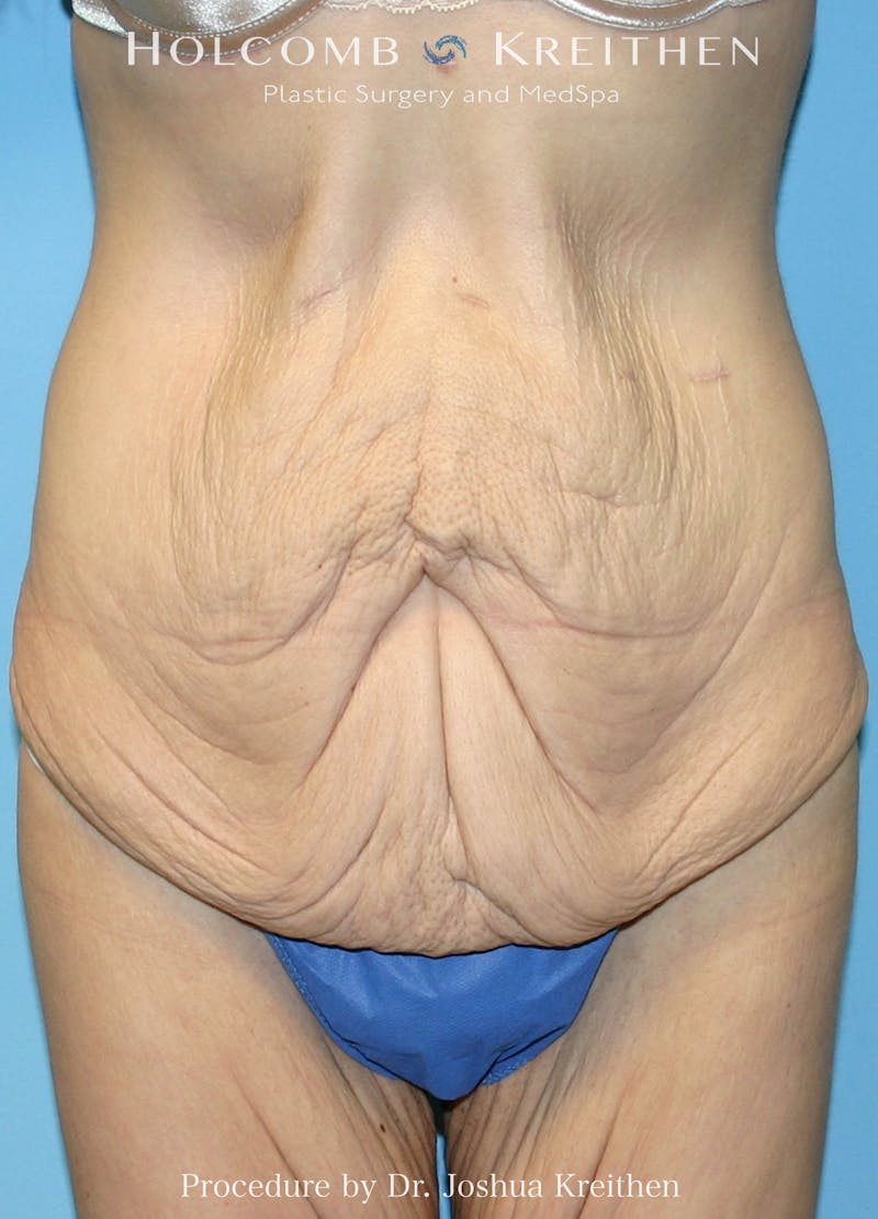 Lower Body Lift Before & After Gallery - Patient 217662 - Image 1