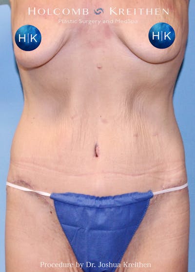 Lower Body Lift Before & After Gallery - Patient 217662 - Image 2