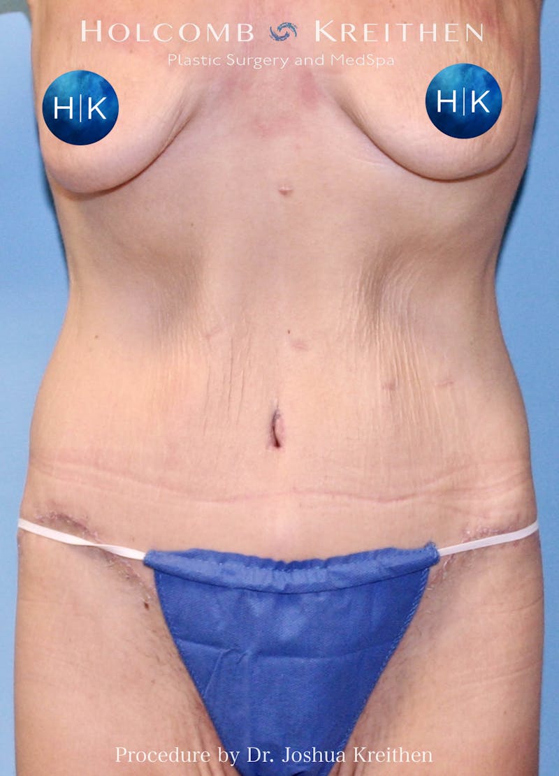 Lower Body Lift Before & After Gallery - Patient 217662 - Image 2