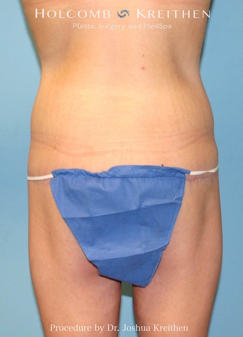 Lower Body Lift Before & After Gallery - Patient 217662 - Image 4