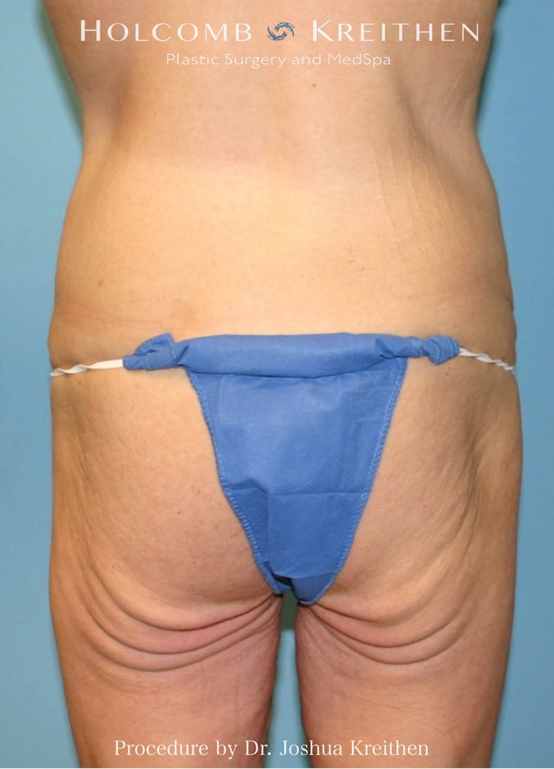 Lower Body Lift Before & After Gallery - Patient 217662 - Image 3