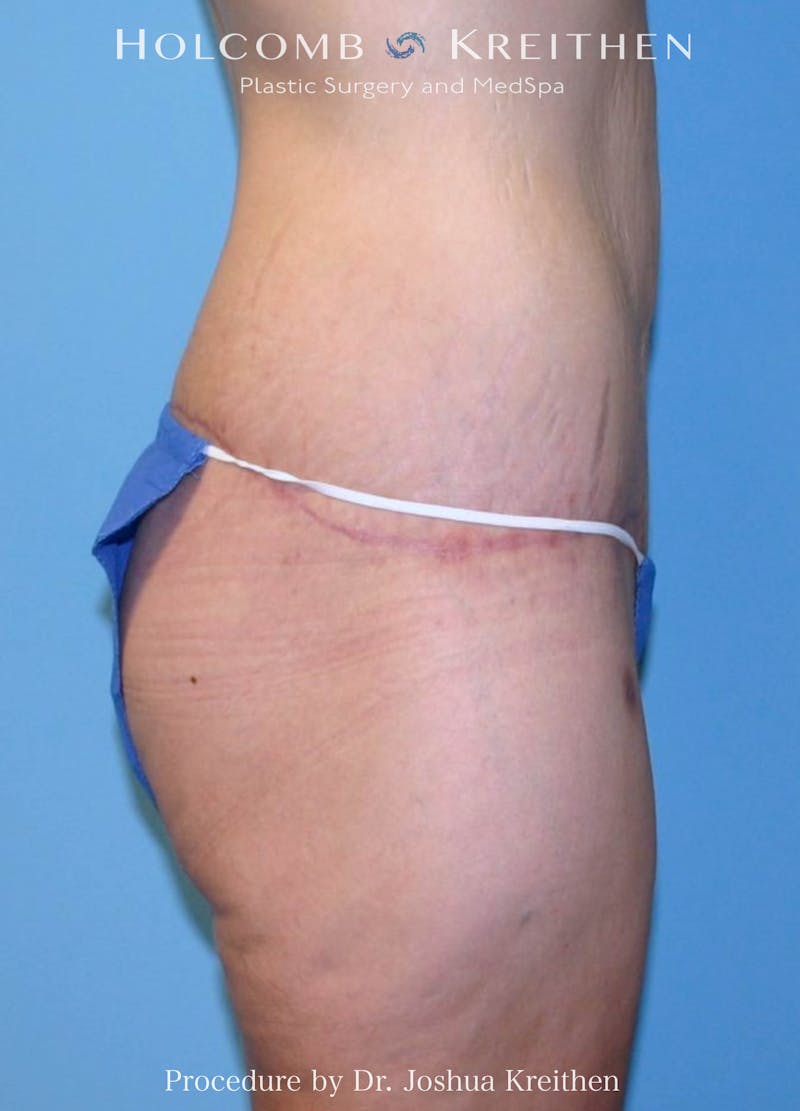 Lower Body Lift Before & After Gallery - Patient 204957 - Image 2