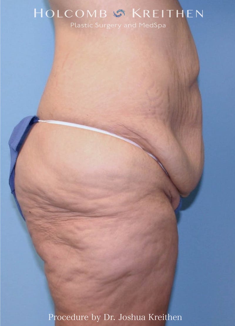 Lower Body Lift Before & After Gallery - Patient 204957 - Image 1