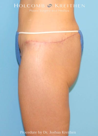 Lower Body Lift Before & After Gallery - Patient 243919 - Image 2