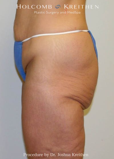 Lower Body Lift Before & After Gallery - Patient 243919 - Image 1