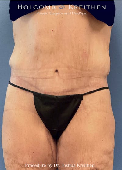 Lower Body Lift Before & After Gallery - Patient 720258 - Image 2