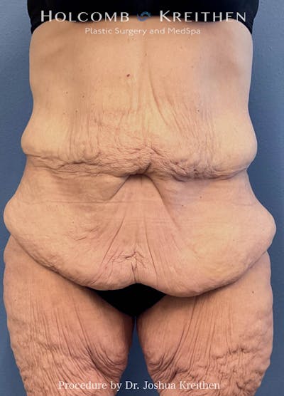 Lower Body Lift Before & After Gallery - Patient 720258 - Image 1