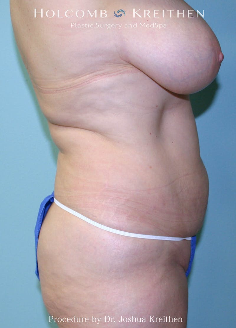 Mommy Makeover Before & After Gallery - Patient 384342 - Image 1