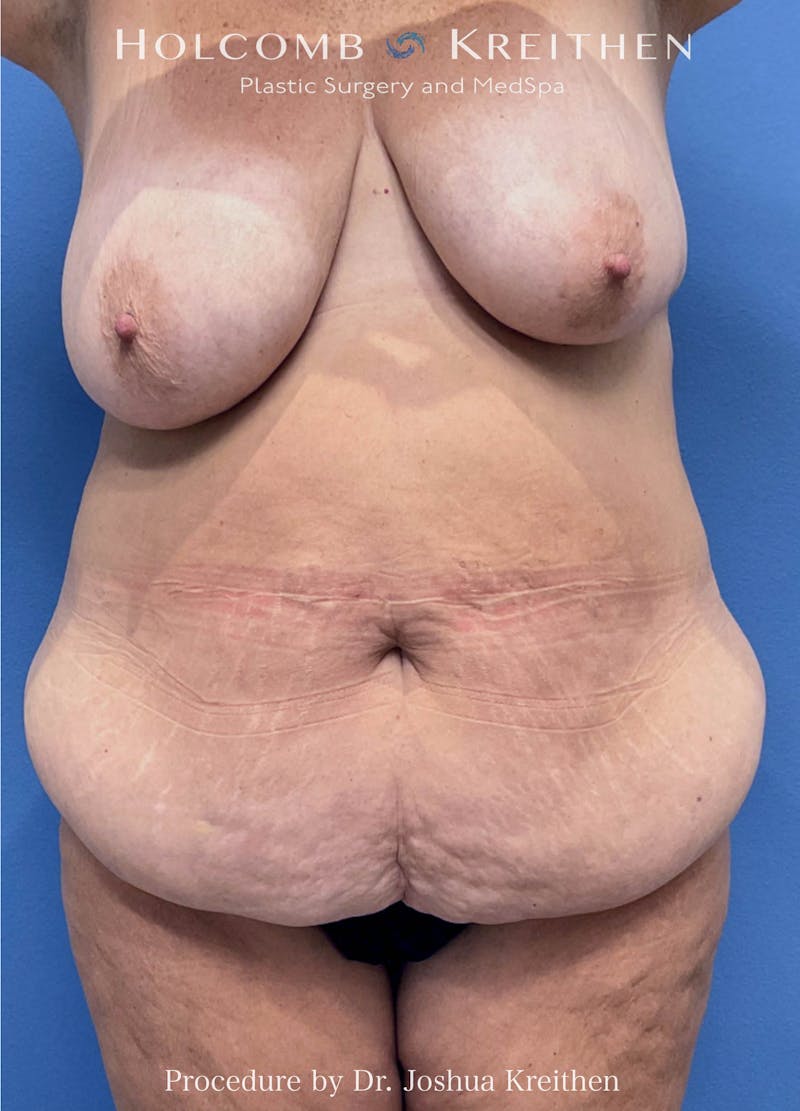 Mommy Makeover Before & After Gallery - Patient 417154 - Image 1