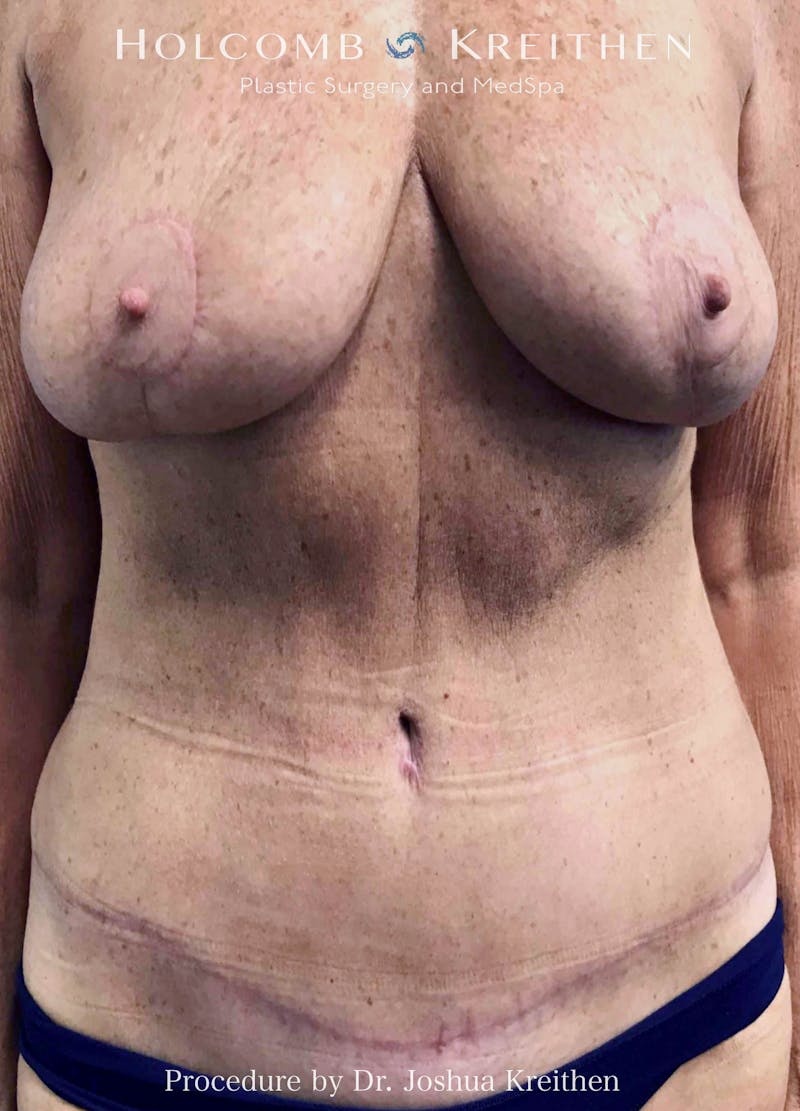 Mommy Makeover Before & After Gallery - Patient 266032 - Image 2