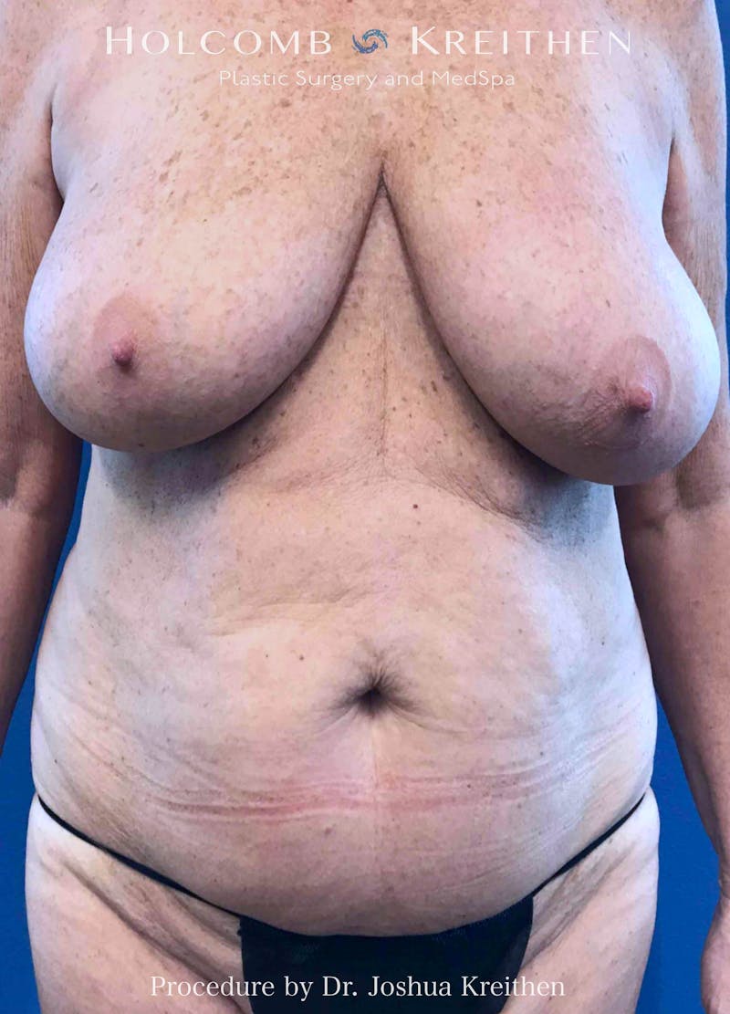 Mommy Makeover Before & After Gallery - Patient 266032 - Image 1