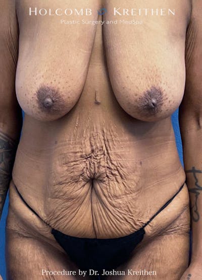 Mommy Makeover Before & After Gallery - Patient 274868 - Image 1