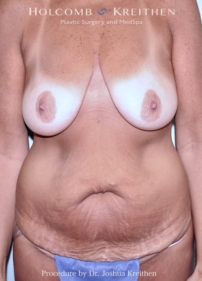 Mommy Makeover Before & After Gallery - Patient 585768 - Image 1