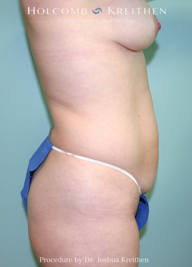 Mommy Makeover Before & After Gallery - Patient 303005 - Image 1