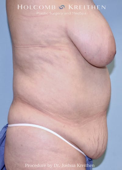 Mommy Makeover Before & After Gallery - Patient 137991 - Image 1