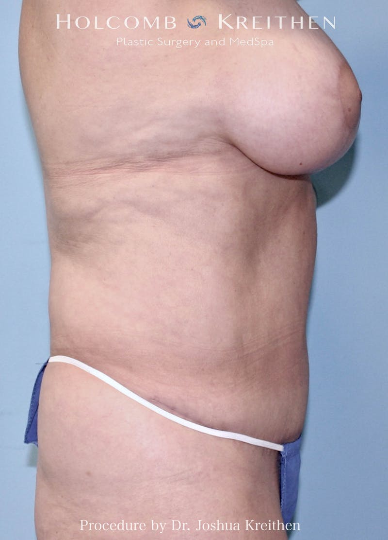 Mommy Makeover Before & After Gallery - Patient 137991 - Image 2