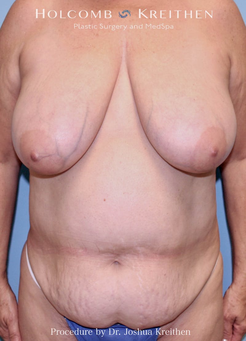 Mommy Makeover Before & After Gallery - Patient 137991 - Image 3