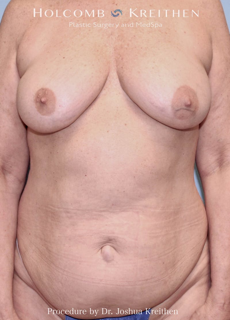 Mommy Makeover Before & After Gallery - Patient 148148 - Image 5