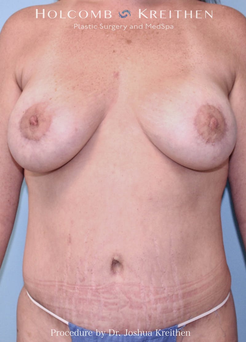 Mommy Makeover Before & After Gallery - Patient 361521 - Image 4
