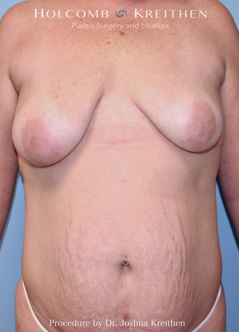 Mommy Makeover Before & After Gallery - Patient 361521 - Image 3