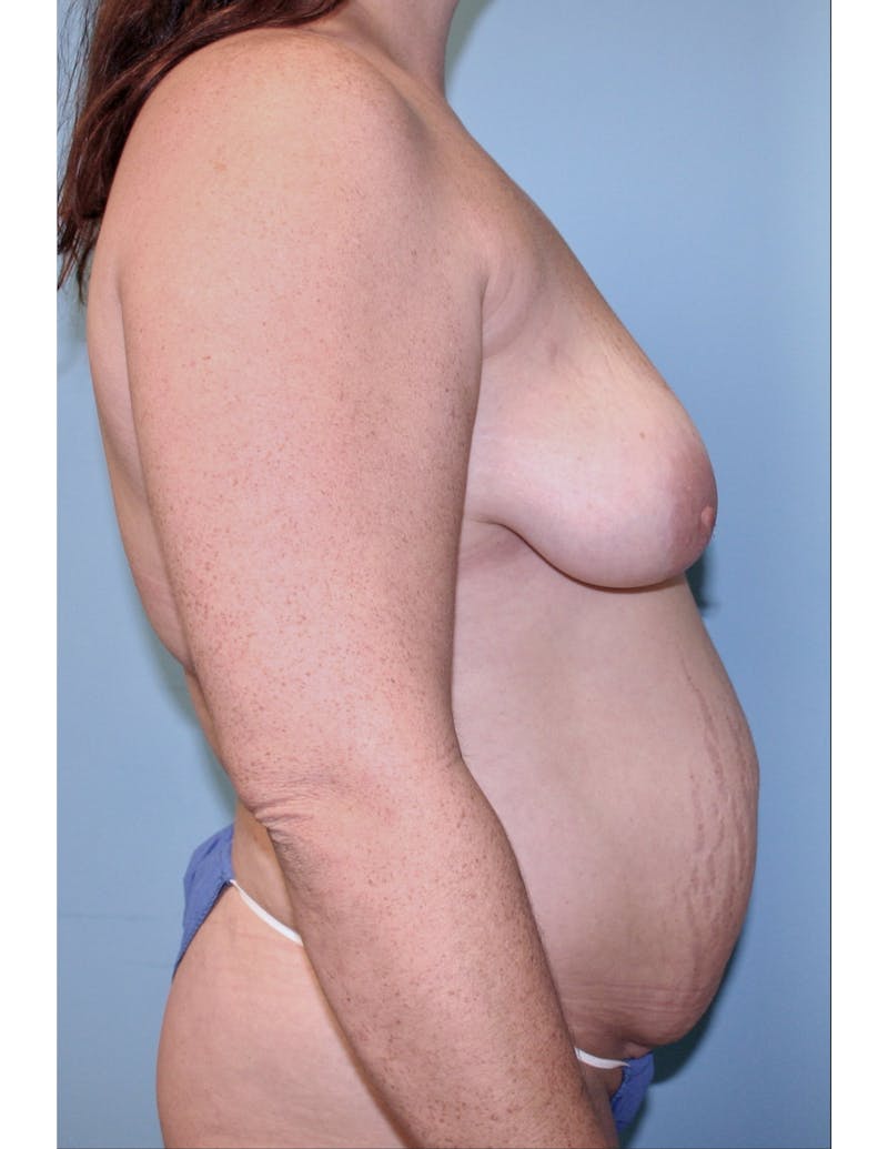Mommy Makeover Before & After Gallery - Patient 337048 - Image 1