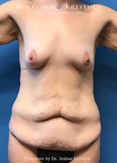 Mommy Makeover Before & After Gallery - Patient 388425 - Image 1