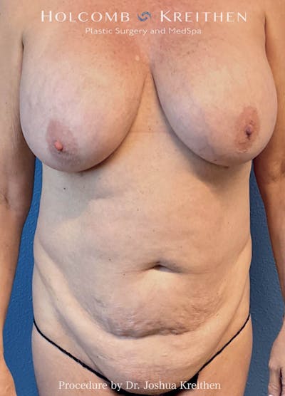 Mommy Makeover Before & After Gallery - Patient 146820 - Image 1