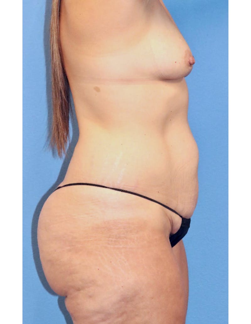 Mommy Makeover Before & After Gallery - Patient 427248 - Image 3