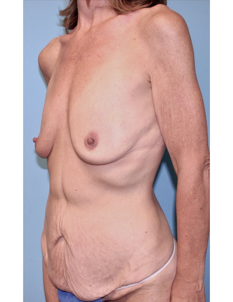 Mommy Makeover Before & After Gallery - Patient 324479 - Image 3