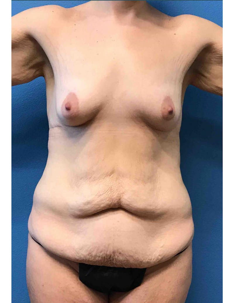 Mommy Makeover Before & After Gallery - Patient 300745 - Image 1
