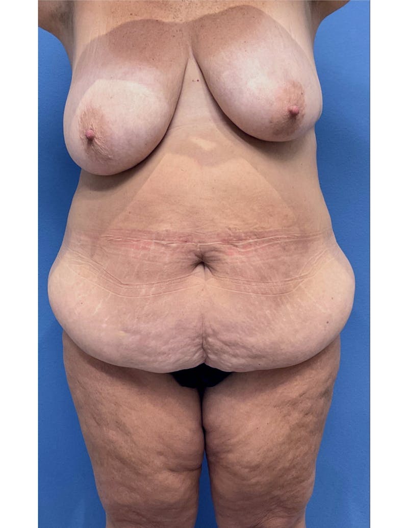 Mommy Makeover Before & After Gallery - Patient 268254 - Image 1