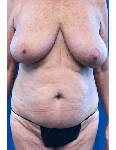 Mommy Makeover Before & After Gallery - Patient 232933 - Image 1