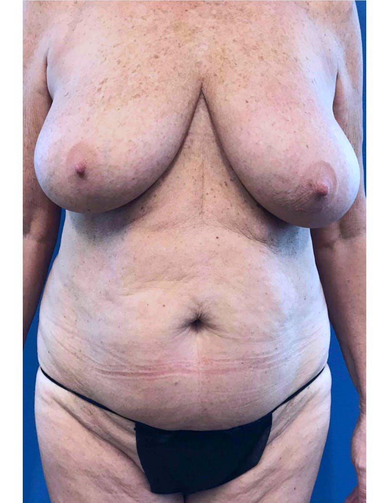 Mommy Makeover Before & After Gallery - Patient 232933 - Image 1
