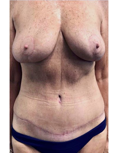Mommy Makeover Before & After Gallery - Patient 232933 - Image 2