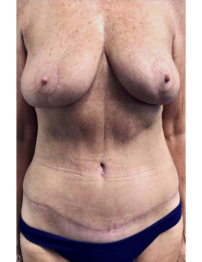 Mommy Makeover Before & After Gallery - Patient 232933 - Image 2