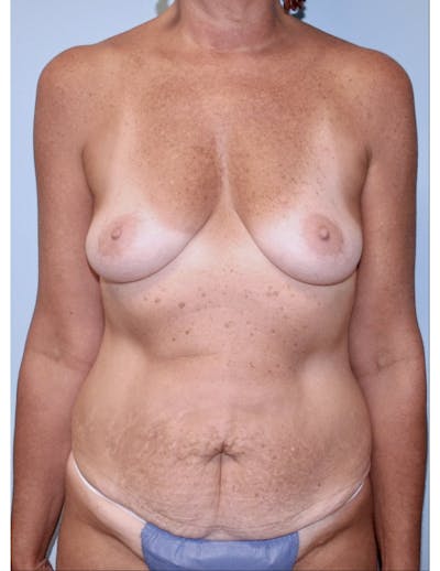 Mommy Makeover Before & After Gallery - Patient 312624 - Image 1