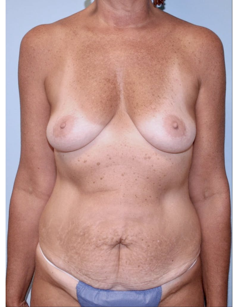 Mommy Makeover Before & After Gallery - Patient 312624 - Image 1