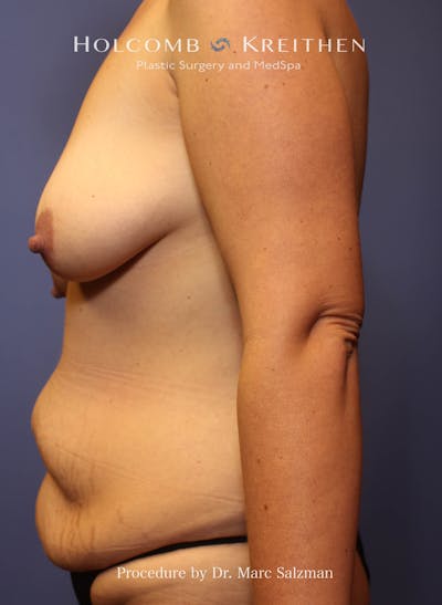 Mommy Makeover Before & After Gallery - Patient 421336 - Image 1