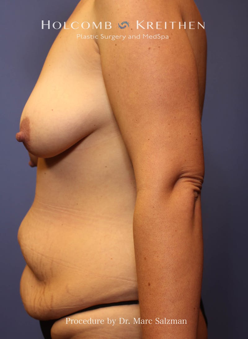 Mommy Makeover Before & After Gallery - Patient 421336 - Image 1