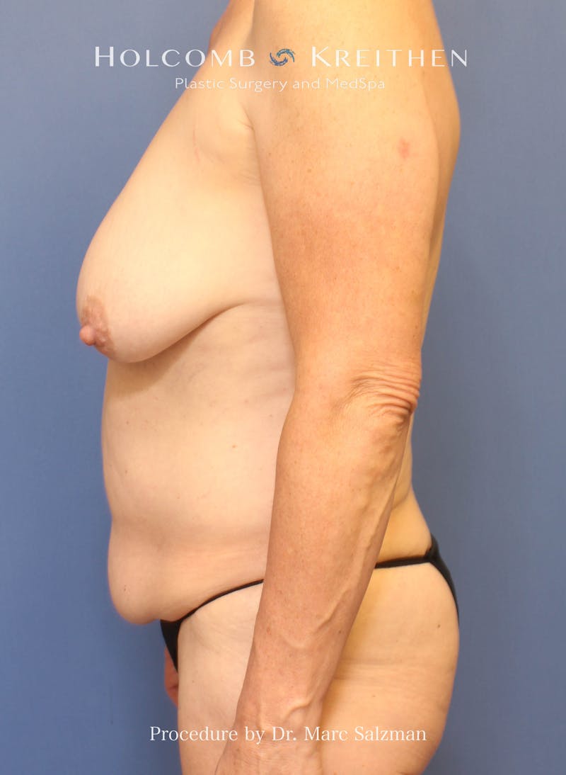 Mommy Makeover Before & After Gallery - Patient 187264 - Image 5