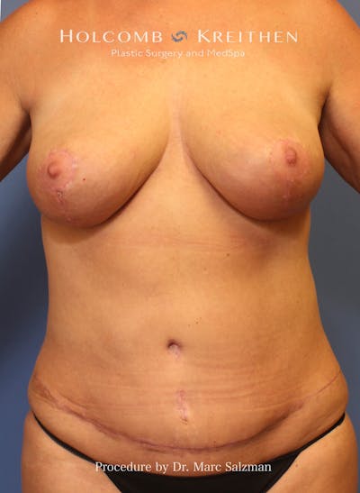 Mommy Makeover Before & After Gallery - Patient 109817 - Image 2