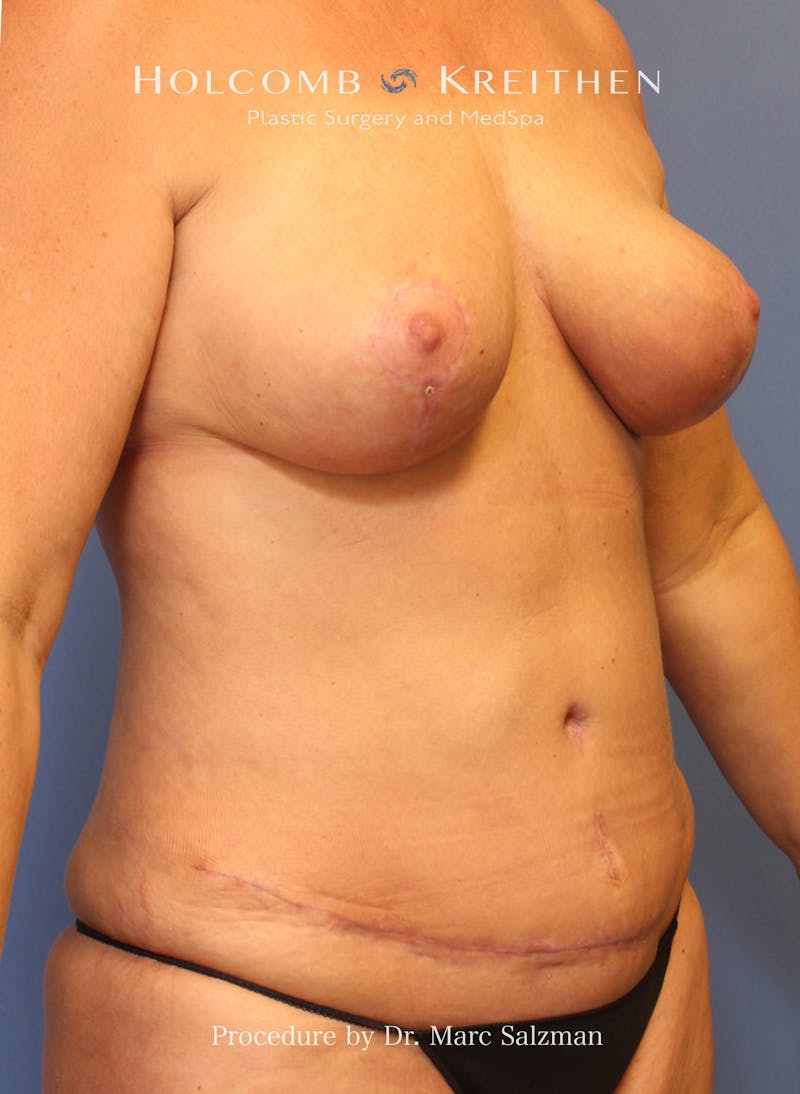 Mommy Makeover Before & After Gallery - Patient 109817 - Image 4